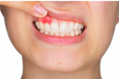 The Silent Alarm: Why Your Gums Bleed